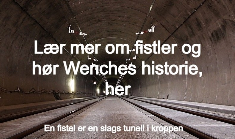 Fistler ved Crohns sykdom Fistler ved Crohns sykdom